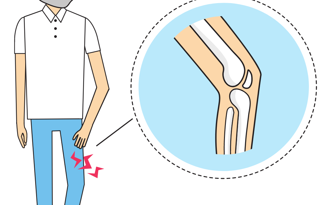 Revision Knee Surgery