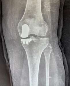 Robotic partial knee replacement in Mumbai