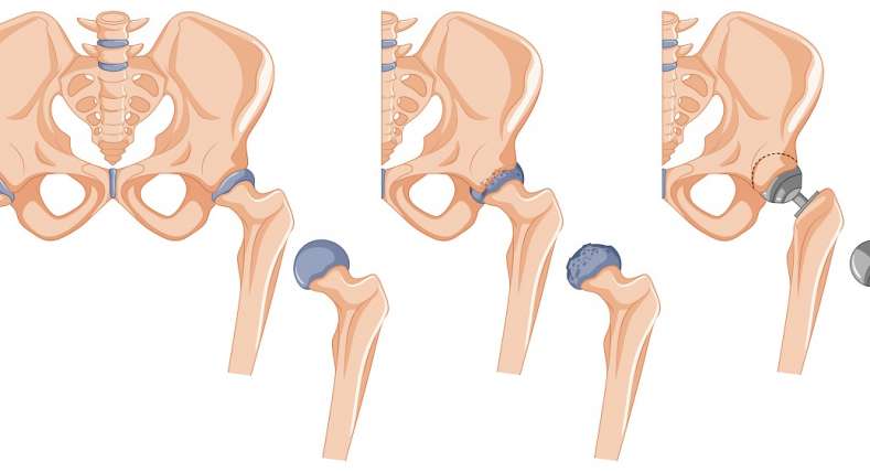 Hip replacement Surgeon in Thane