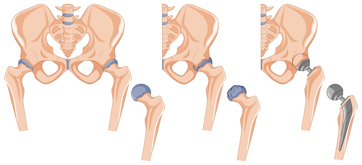 Hip replacement Surgeon in Thane